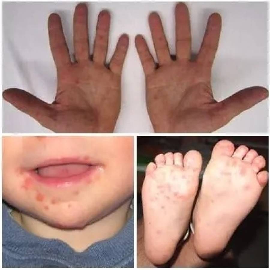 Síndrome de boca, manos y pies: padecimiento común en infantes (+ Audio)