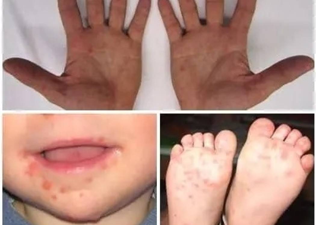 Síndrome de boca, manos y pies: padecimiento común en infantes (+ Audio)